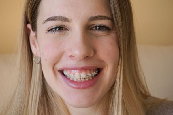 Clear Braces Vs Aligners: Important Differences To Keep In Mind
