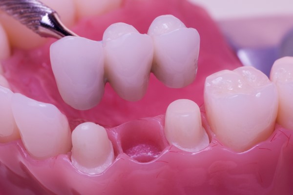 How A Dental Bridge Can Improve Your Oral Health