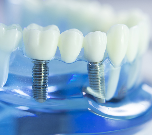 Bridgewater Dental Implants
