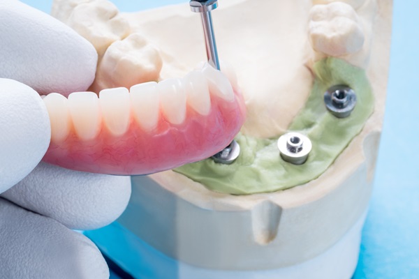 Things To Know About Implant Supported Dentures